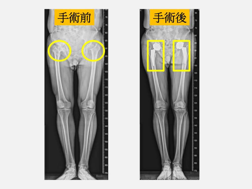▲病人雙側髖關節嚴重關節炎（左圖圓圈處），接受雙側微創人工髖關節置換手術回到正常生活（右圖方框處）。（大里仁愛醫院提供）