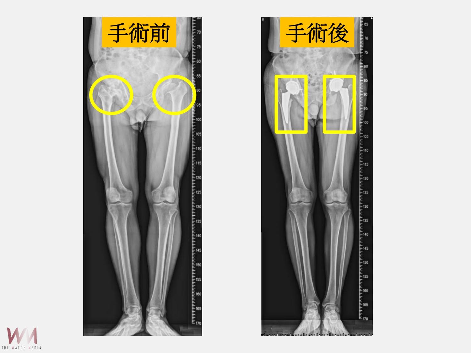 微創人工髖關節置換手術　助綠衣天使重返職場、生活日常 - https://www.watchmedia01.com