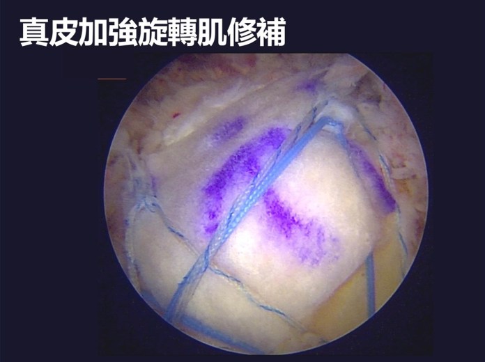 長期搬重物導致旋轉肌破裂 聯新國際醫籲把握黃金治療期 52 郭亮增醫師 2 0