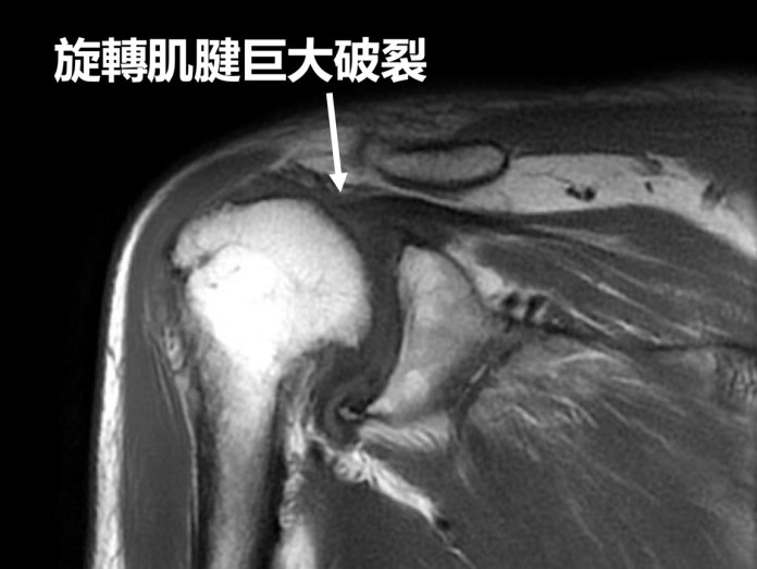 長期搬重物導致旋轉肌破裂 聯新國際醫籲把握黃金治療期 53 郭亮增醫師 3 0