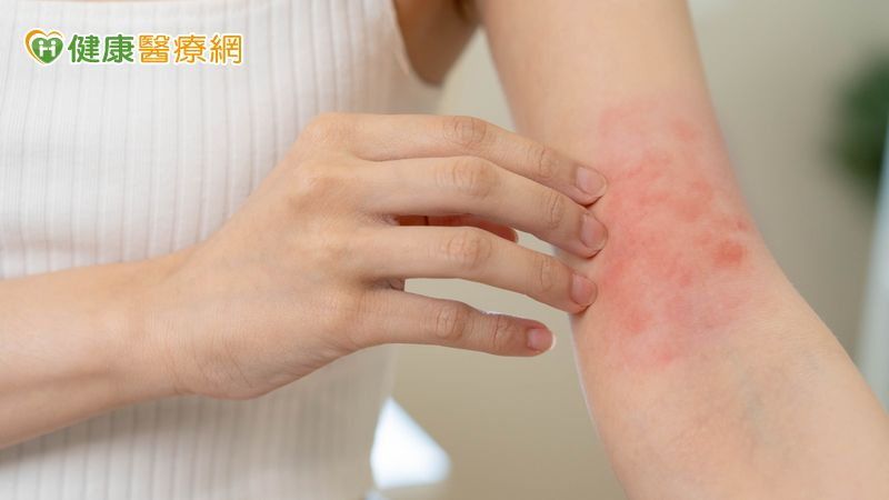 異位性皮膚炎來勢洶洶! 醫授「日常3大保養原則」一定要做到