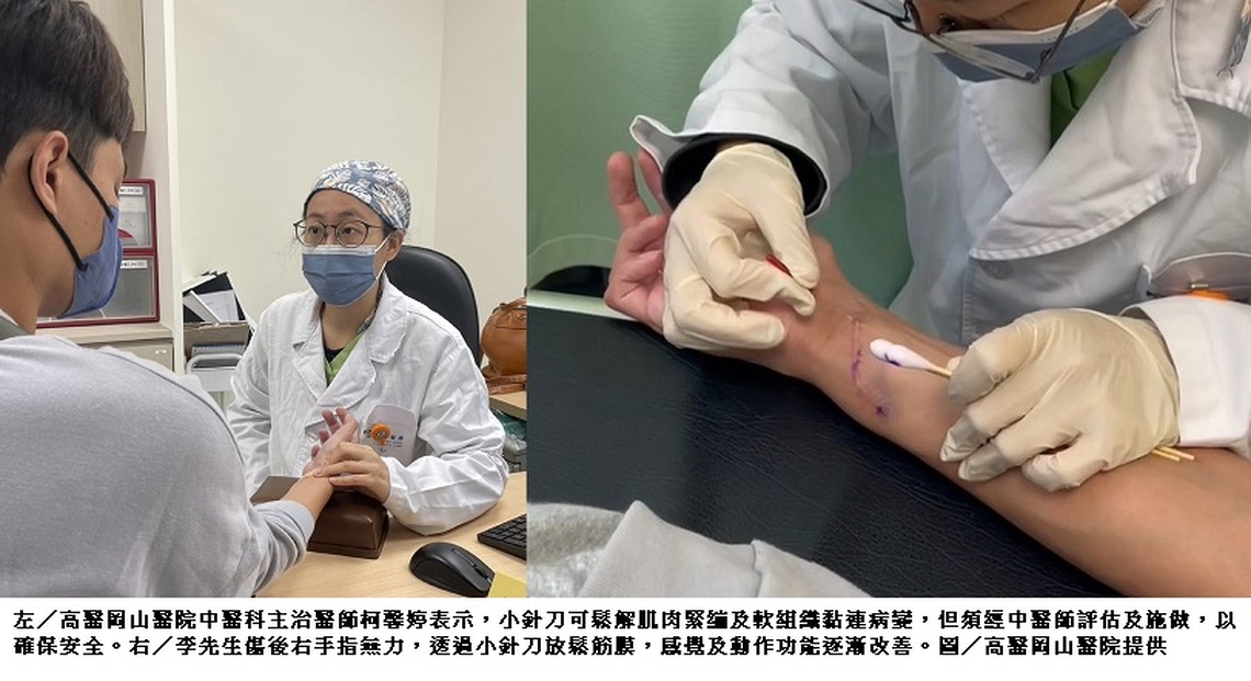 「手指能動了!」小針刀疤痕鬆解術助攻 電梯工程師傷後神經修復 盼盡早重返職場