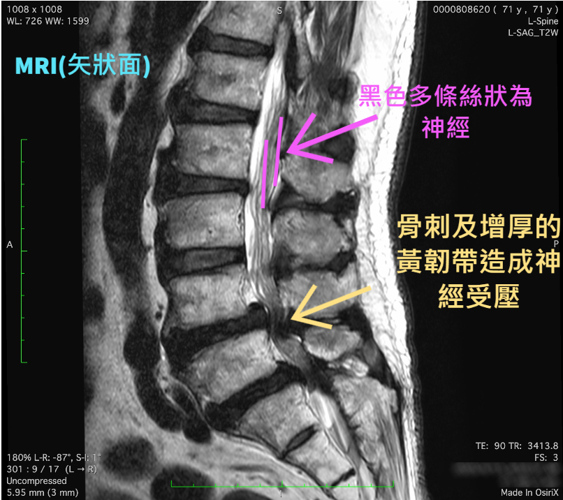 （有影片）／澳門退休長者腰椎狹窄8年不眠　來台接受微創手術一夜好眠