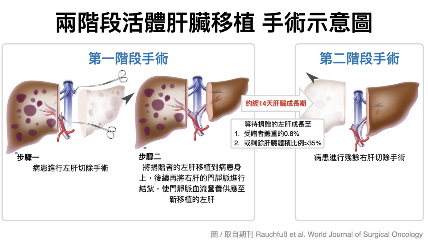 高雄長庚兩階段活體肝移植‧台灣新曙光 助肝臟體積過小之捐贈者 捐肝救家人