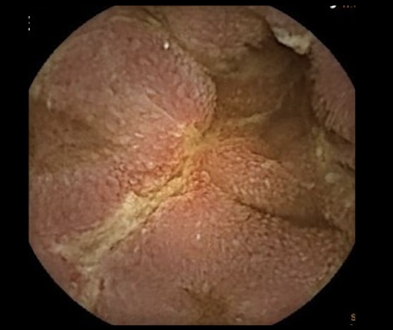 35歲男鬧腹痛、腹瀉一年 竟罹少見「克隆氏症」小腸全潰瘍! 238 35歲男鬧腹痛、腹瀉一年 竟罹少見「克隆氏症」小腸全潰瘍! 237