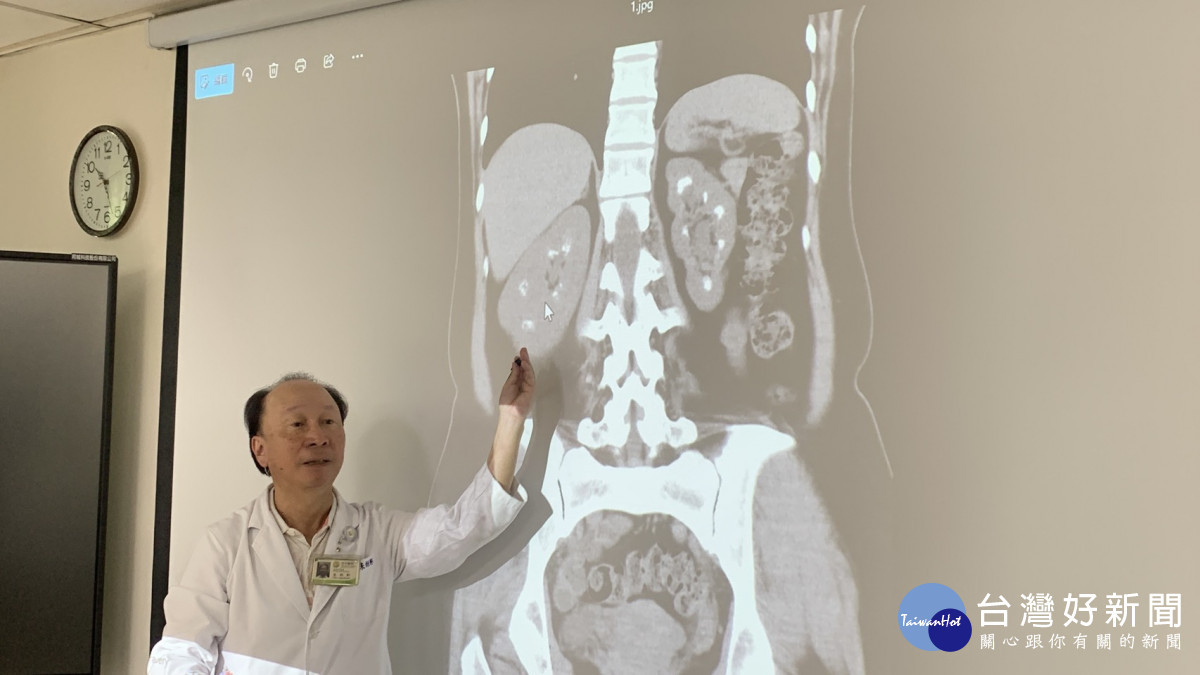 2年5度腎結石 醫揪雙腎像「滿天星」原因竟是副甲狀腺亢進