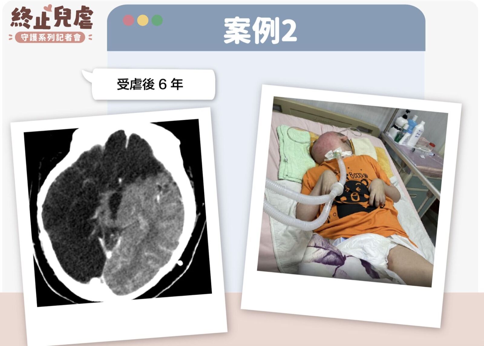 台灣每年26件重大兒虐 一半全是「受虐性腦傷」要命或致殘 190 台灣每年26件重大兒虐 一半全是「受虐性腦傷」要命或致殘 189