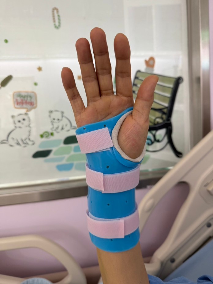 7旬婦滑倒手腕腫脹變形 部桃醫助她恢復正常生活 70 S 89702778 0