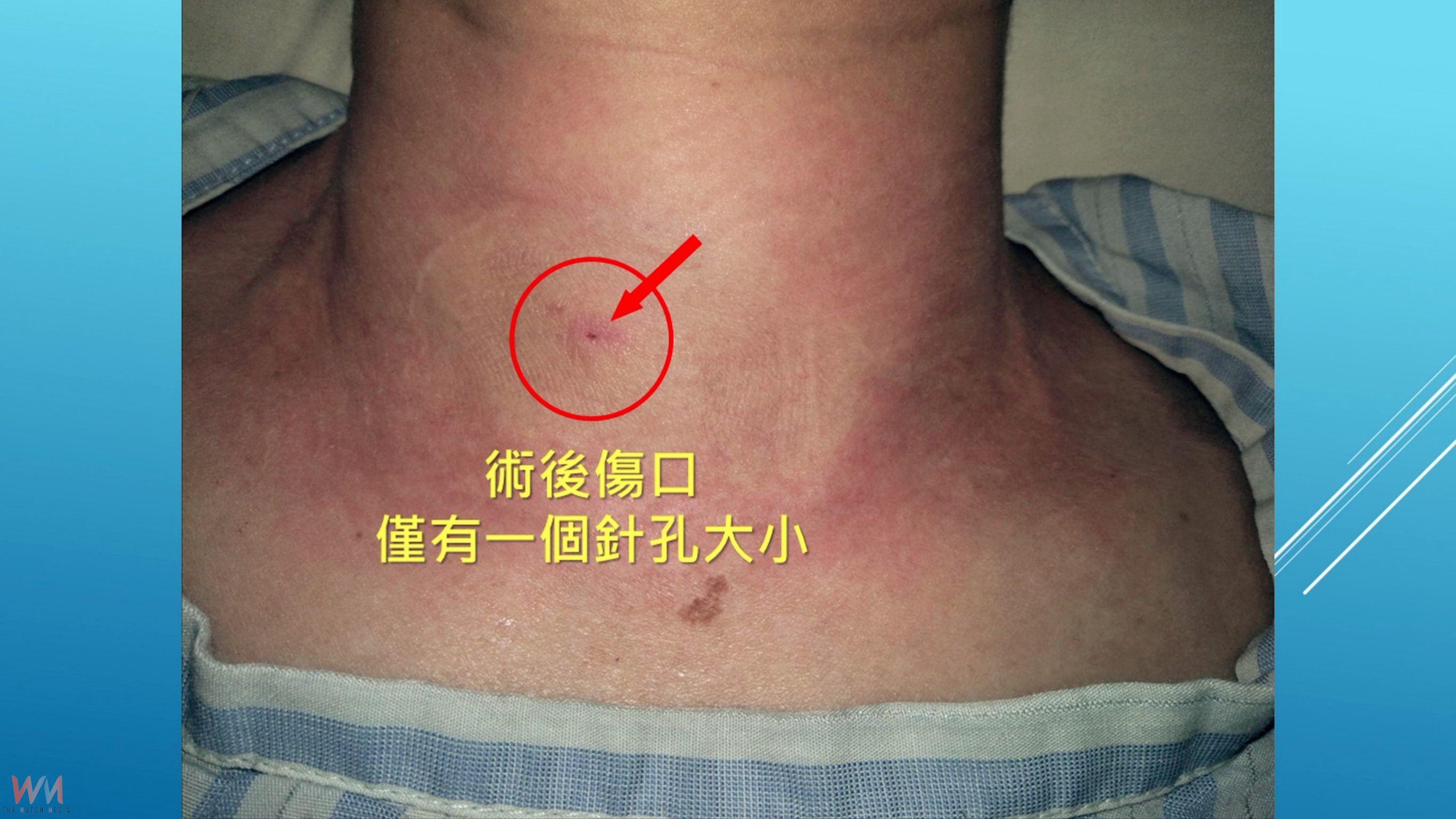 上班族頸腫瘤近4公分 消融術治療除病灶保留器官與功能 - https://www.watchmedia01.com