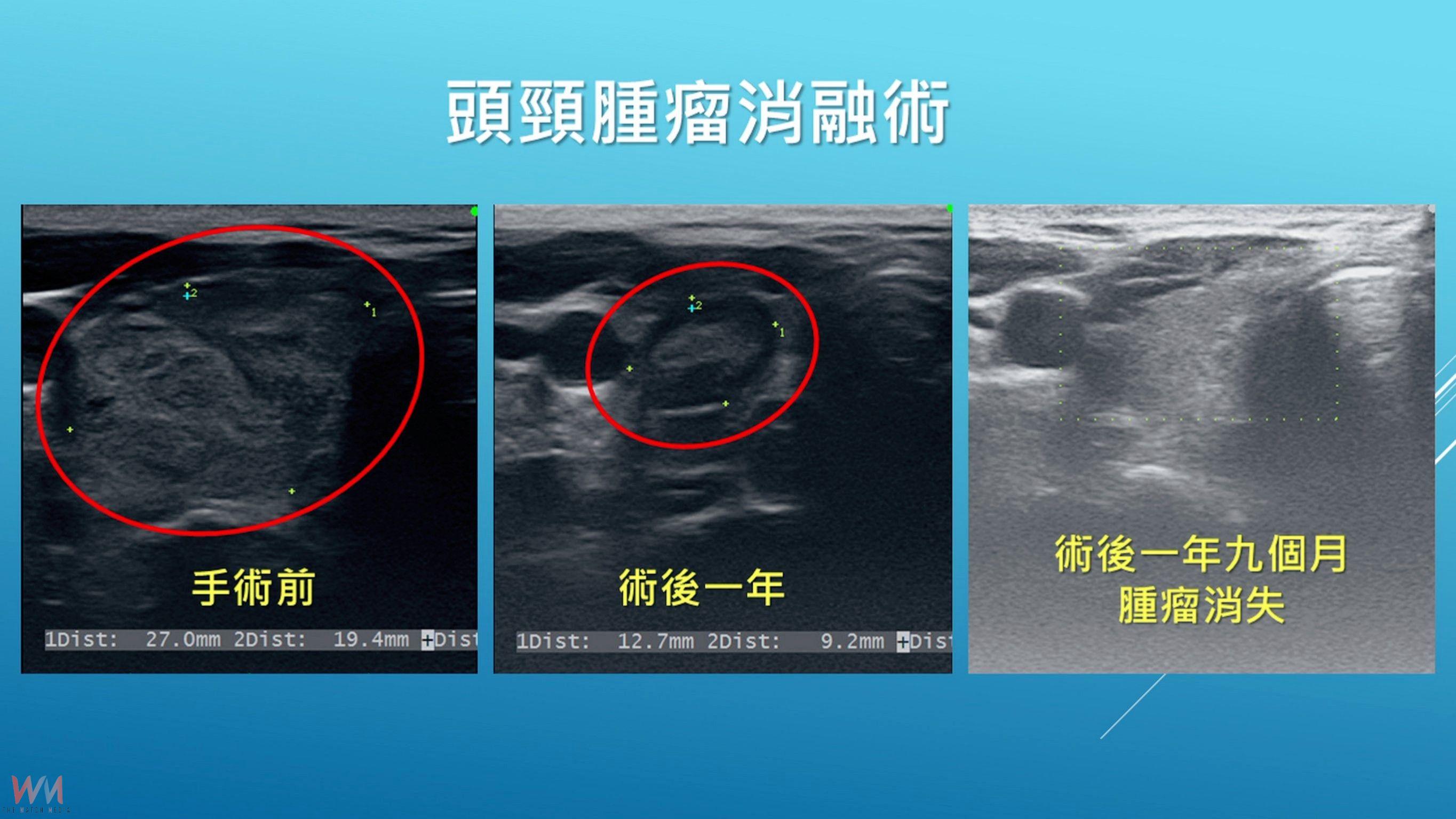上班族頸腫瘤近4公分 消融術治療除病灶保留器官與功能 - https://www.watchmedia01.com