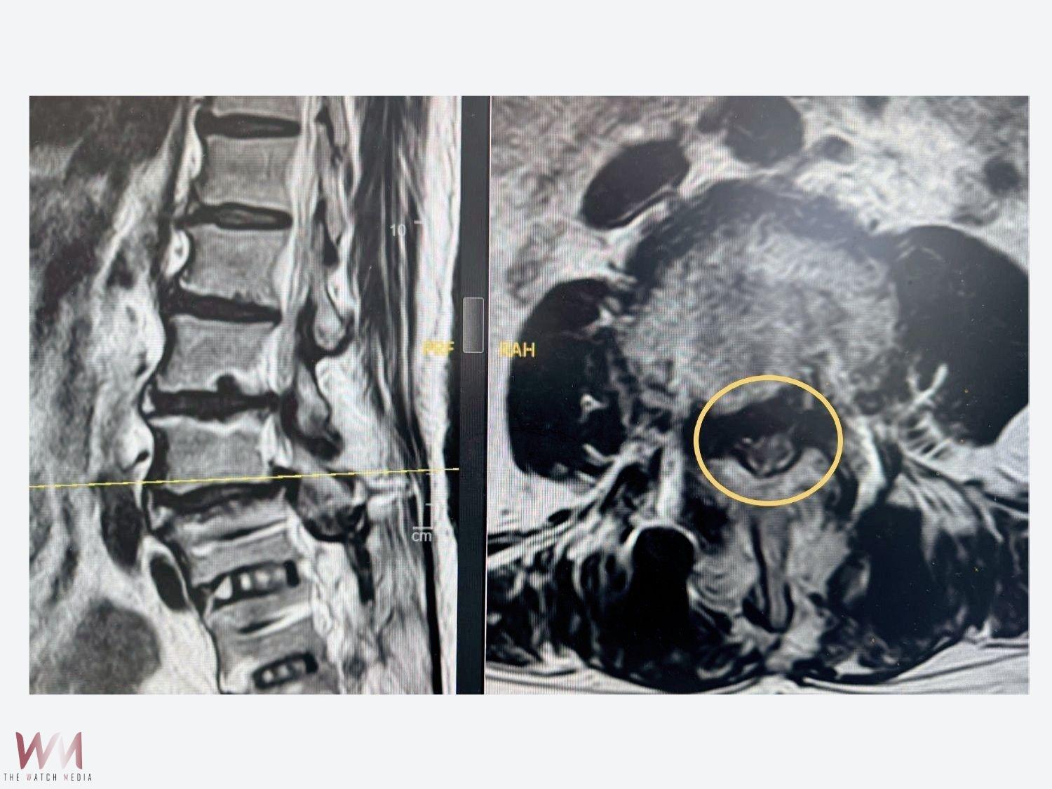鄰近節脊椎狹窄症 「微創脊椎內視鏡減壓手術」助改善 恢復日常生活 - https://www.watchmedia01.com