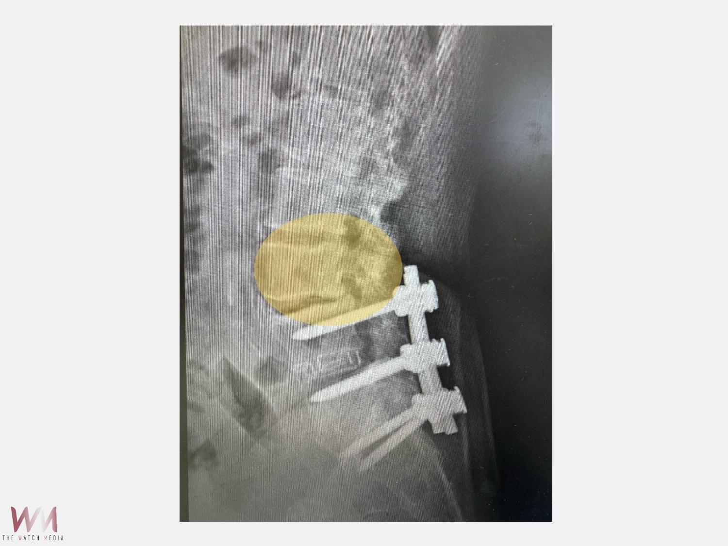 鄰近節脊椎狹窄症 「微創脊椎內視鏡減壓手術」助改善 恢復日常生活 - https://www.watchmedia01.com