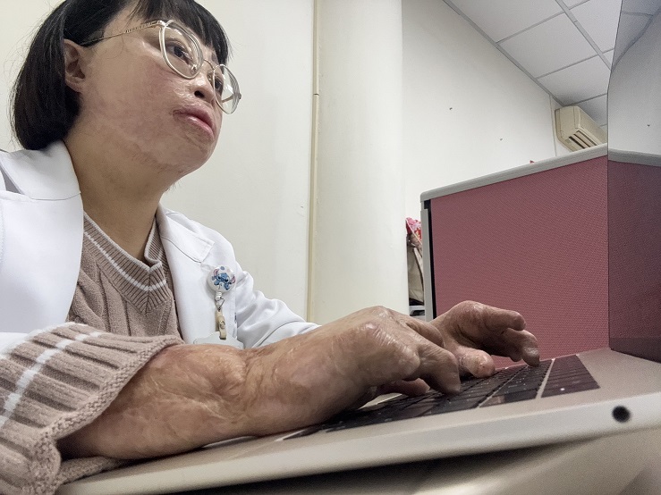 ▲嚴重燒傷的承怡今已成為一名社工師。