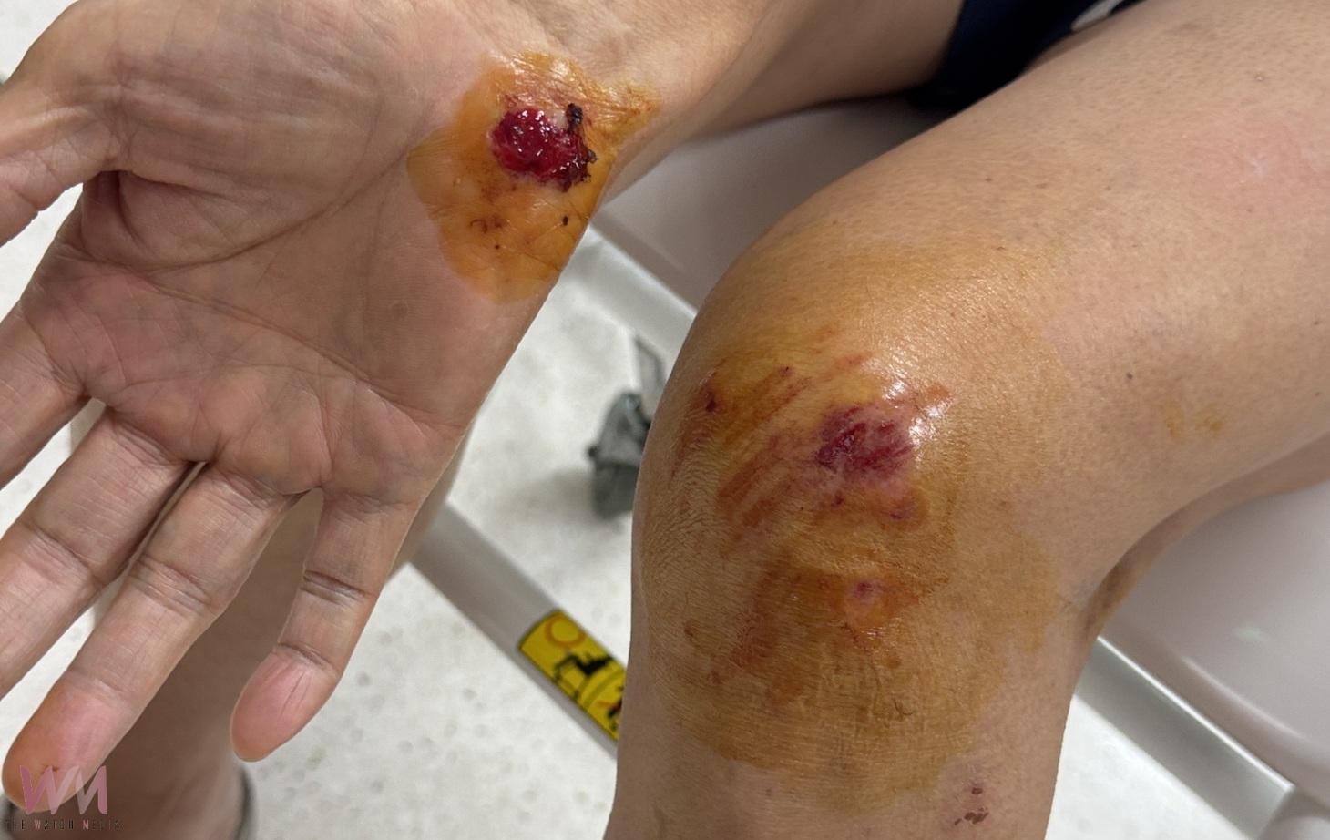 北港老嫗夜歸遭人行道突起柏油絆倒 臉部著地多處受傷盼儘速改善 - https://www.watchmedia01.com