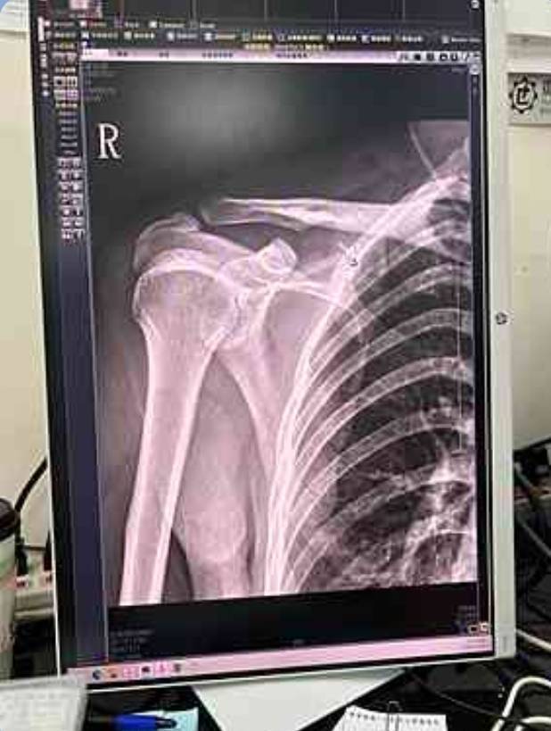 陳姓受害者除右肩胛骨骨折外,另有頭部外傷及身體多處擦挫傷。(圖/民眾提供)