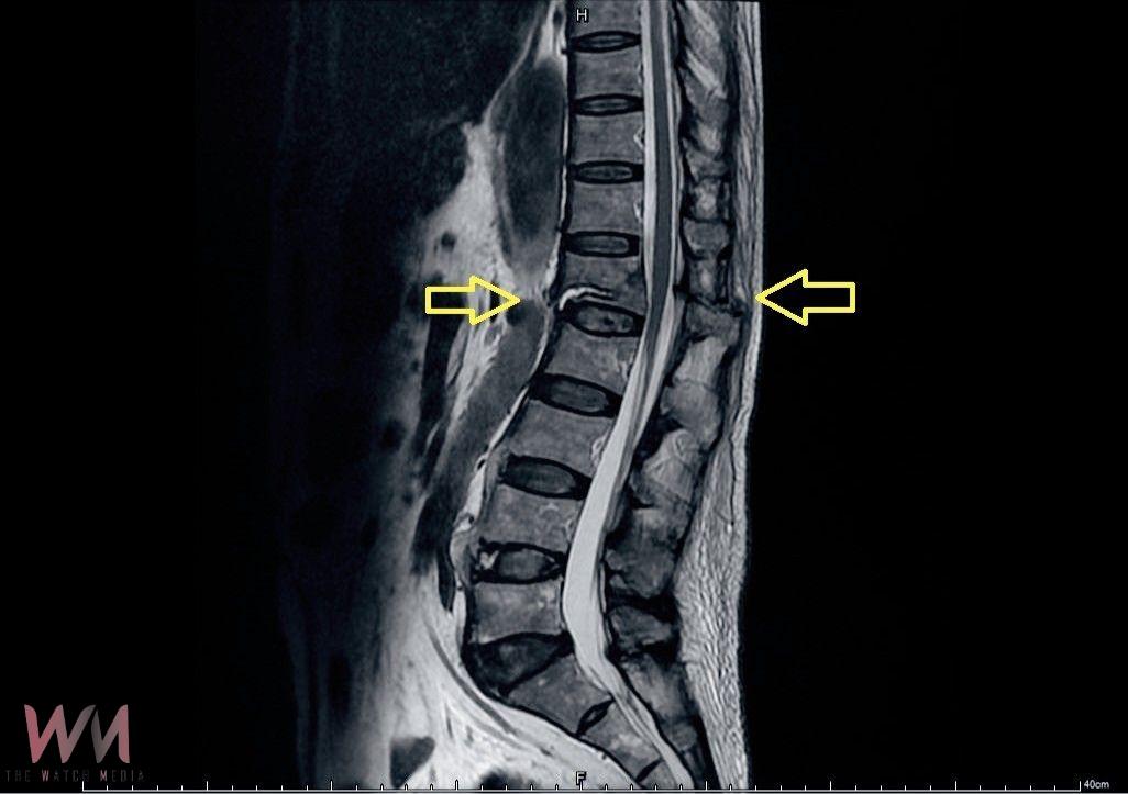 7旬翁背痛竟是危險骨折 長安醫院:僵直性脊椎炎惹禍 - https://www.watchmedia01.com