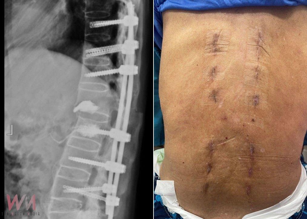 7旬翁背痛竟是危險骨折 長安醫院:僵直性脊椎炎惹禍 - https://www.watchmedia01.com