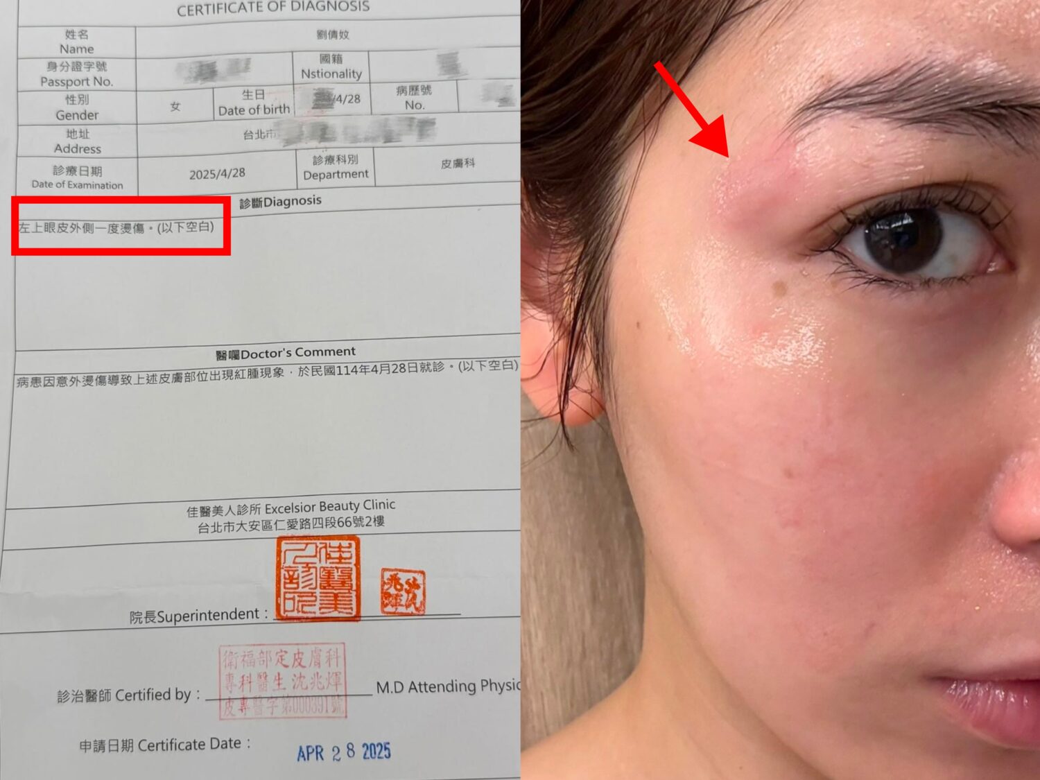 劉倩妏秀出燙傷照及一度燙傷的診斷證明書。(本報合成照片)