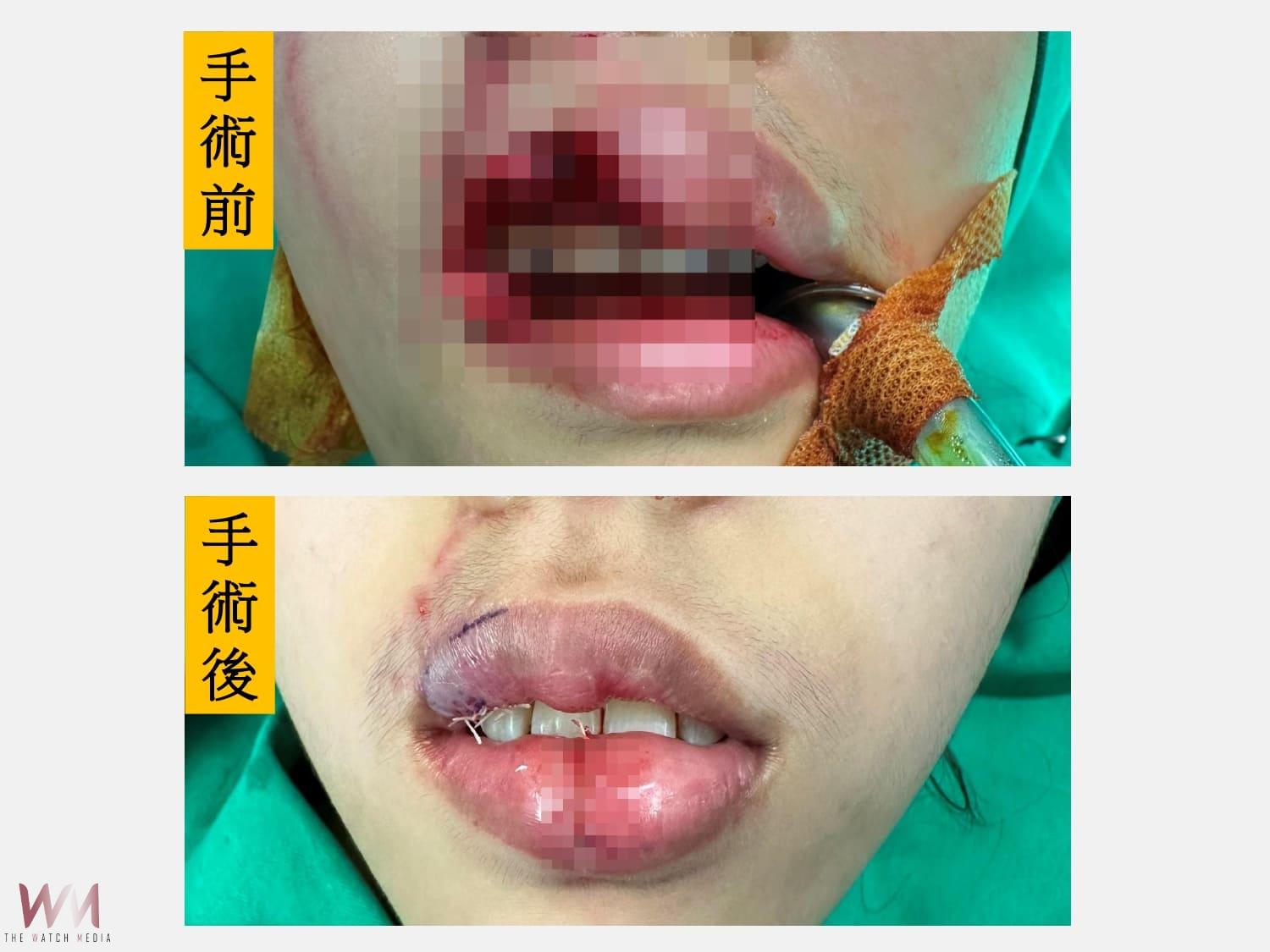 少女遭犬咬毀容 仁愛長庚醫院:3階段手術重建上唇 找回笑容與自信 - https://www.watchmedia01.com