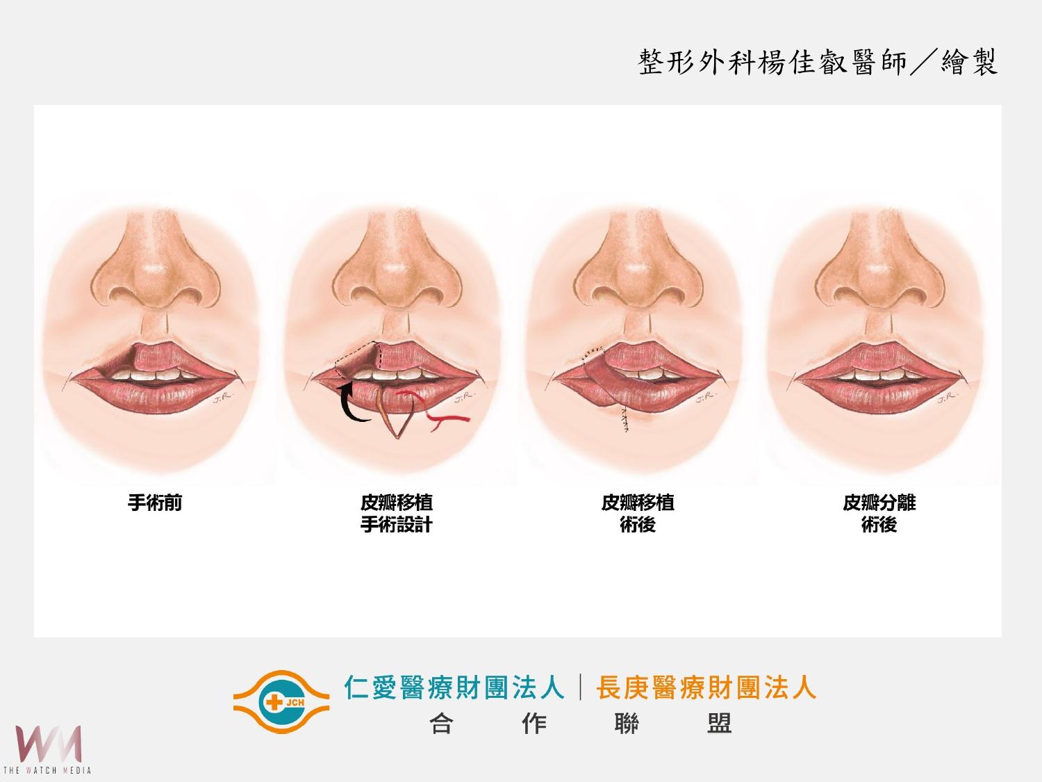 少女遭犬咬毀容 仁愛長庚醫院:3階段手術重建上唇 找回笑容與自信 - https://www.watchmedia01.com