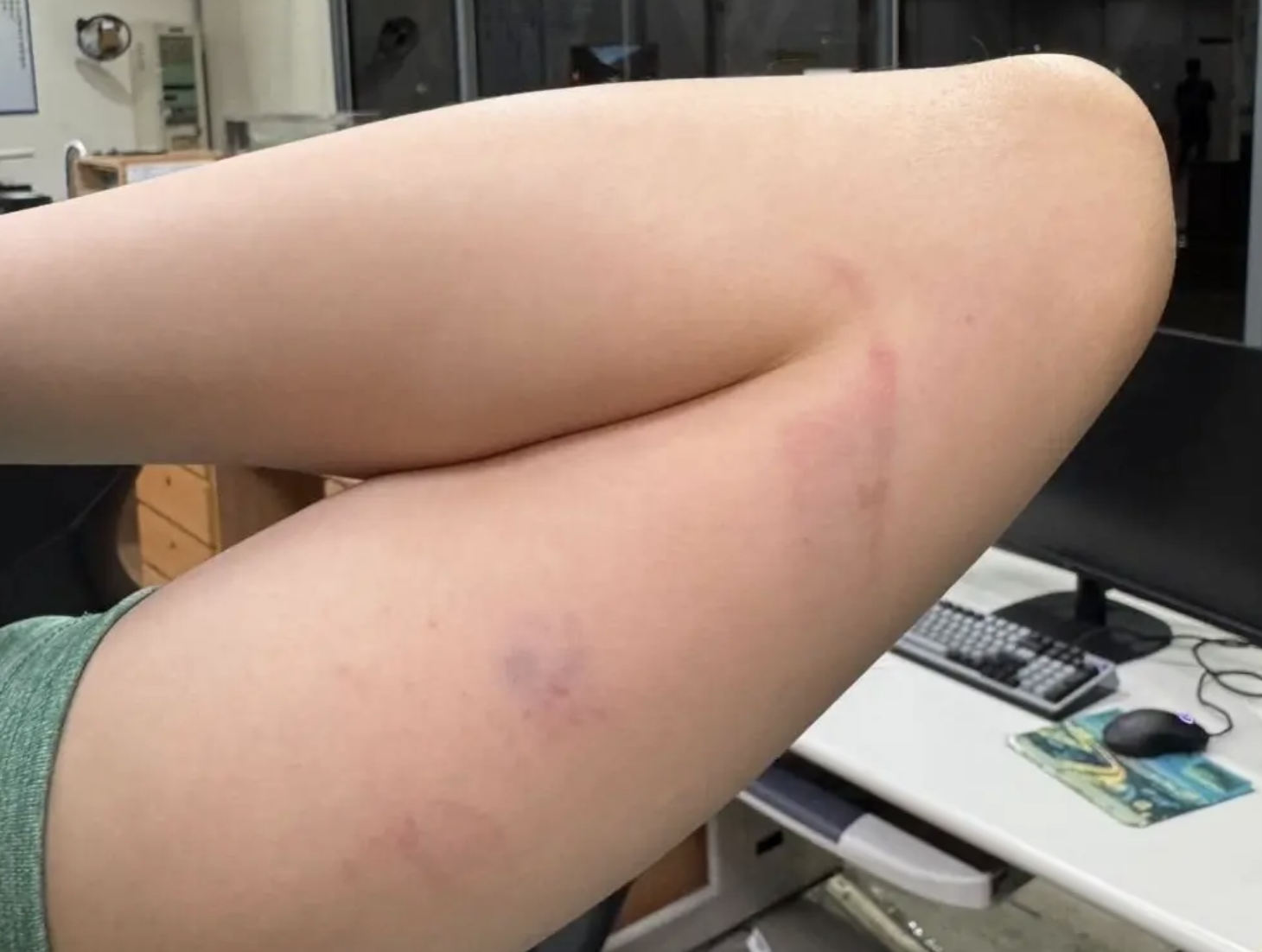 暴走病患持遙控器砸護理師 家屬冷回一句話引爆眾怒