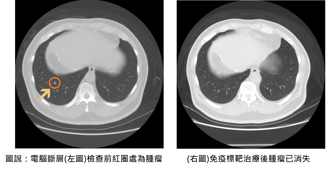 免疫標靶聯合治療為癌友帶來新希望 聯新國際醫院曝延命關鍵 e99bbbe885a6e696b7e5b1a4e6b2bbe79982e5898de5be8ce6af94e8bc83 0 20250605 020050