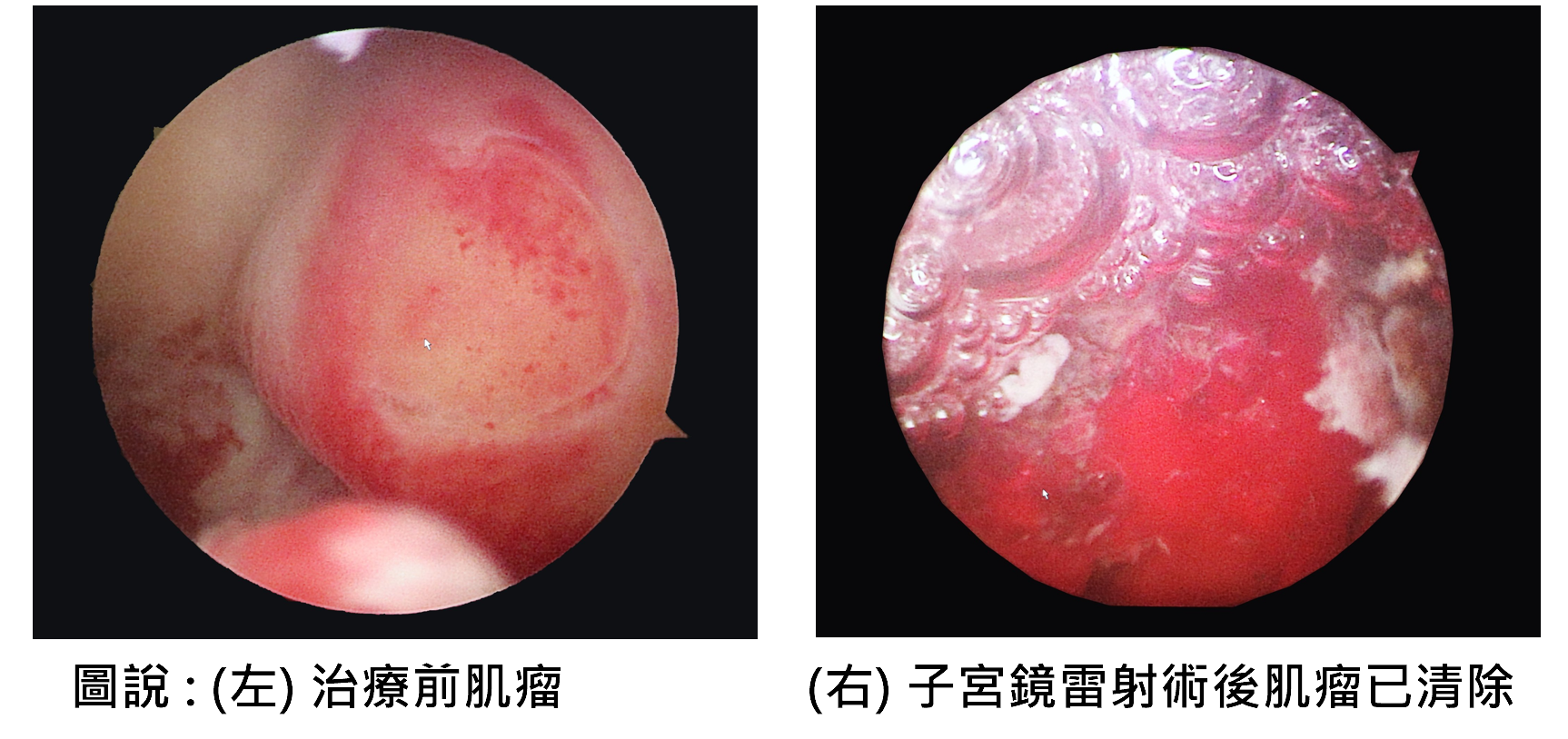 OL下體大出血昏倒 聯新國際醫診斷是這疾病在作祟 03肌瘤手術前後對比照 0