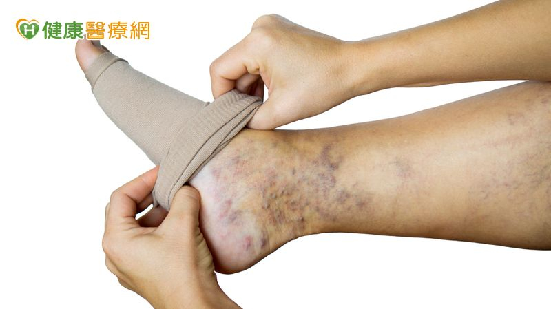 靜脈曲張穿壓力襪過敏沒效? 「這1微創手術」助她找回生活品質