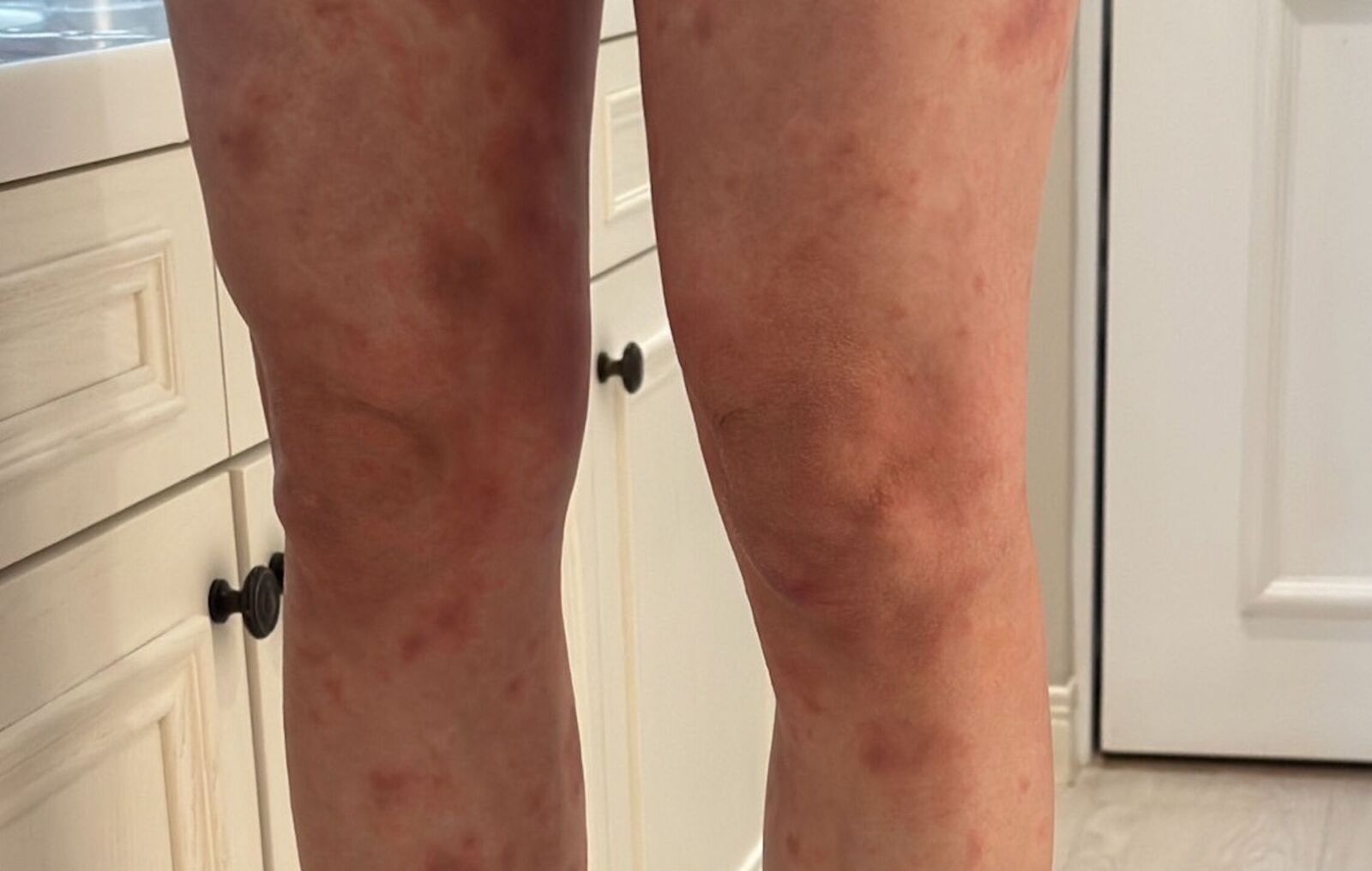 坐月子竟「癢」到全身腫! 妊娠性蕁麻疹小心越補越糟 290 坐月子竟「癢」到全身腫! 妊娠性蕁麻疹小心越補越糟 289