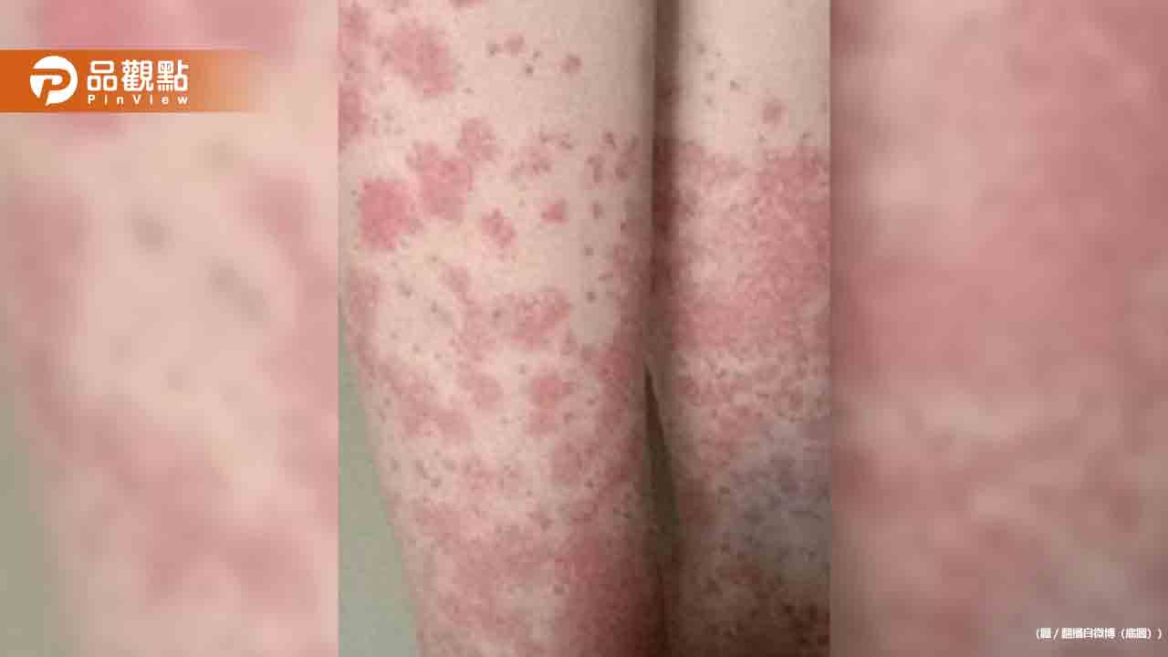 20歲女大生狂染髮「全身爆紫斑」險喪命