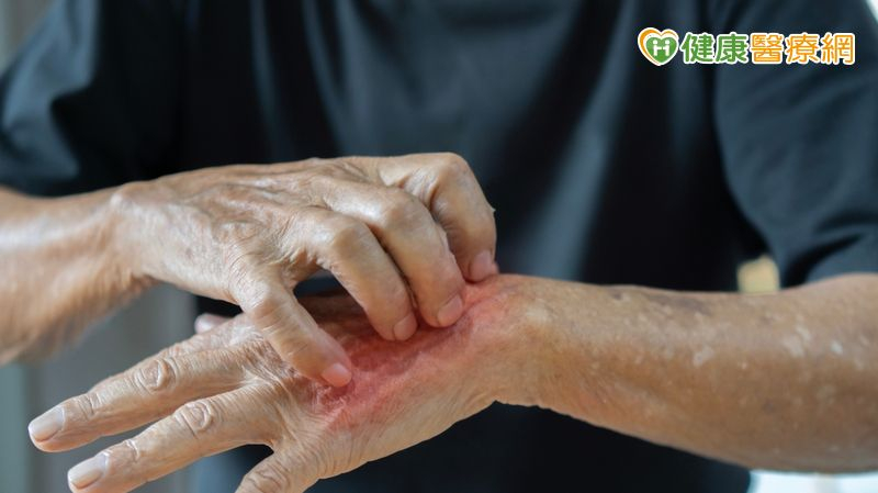 「搔癢、紅疹治不好」竟是疥瘡惹禍 醫解析感染徵兆與處理方式