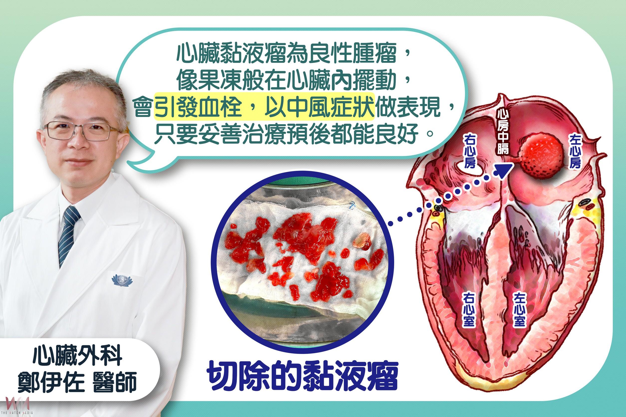 中風竟是心臟黏液瘤作怪 台中慈醫:6旬婦微創開心手術成功救命 - https://www.watchmedia01.com