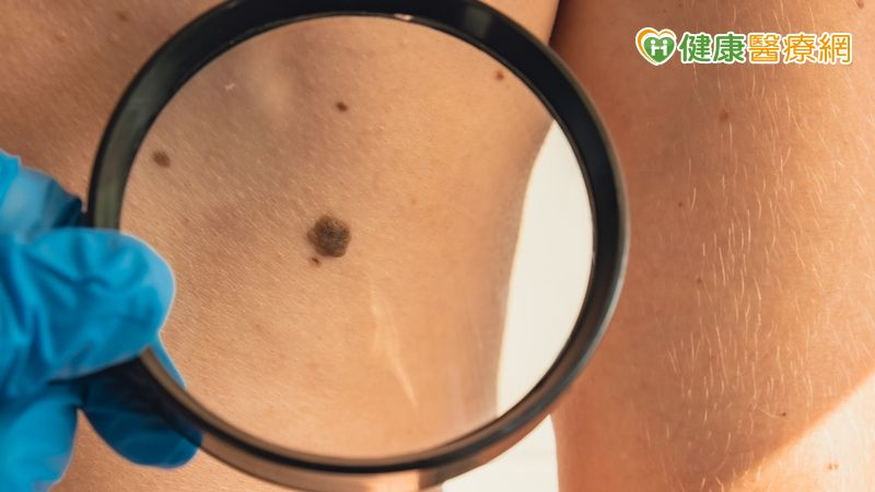 右腳大拇指出現黑塊以為是瘀青 一查竟是皮膚癌