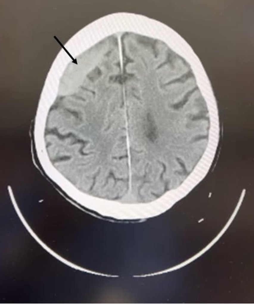 老人跌倒腦出血緊急手術救回一命-醫師呼籲注意頭部外傷