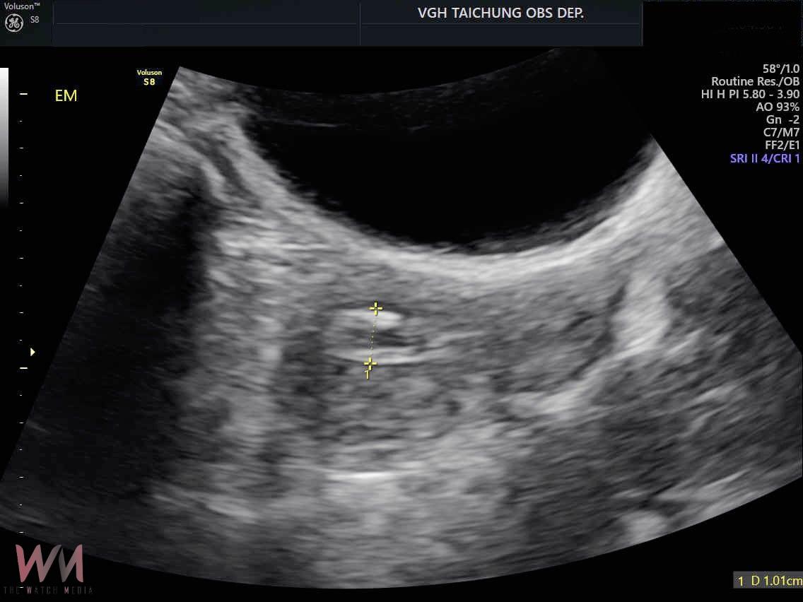 停經後出血 子宮內膜癌上身 台中榮總醫:單孔達文西手術傷口小、恢復快 - https://www.watchmedia01.com