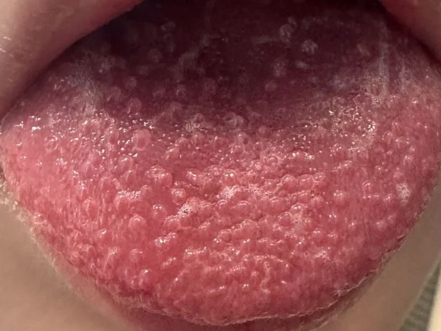 猩紅熱特徵為「草莓舌」