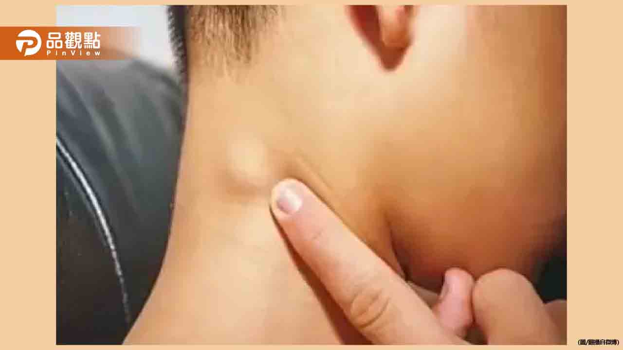 5歲童脖子長「肉疙瘩」竟確診癌症晚期