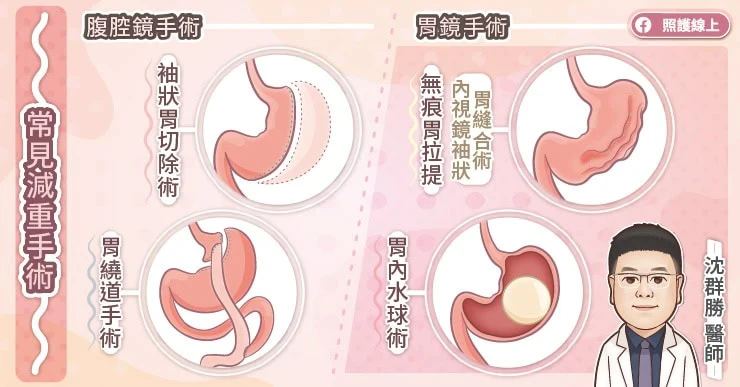 常見4種減重手術