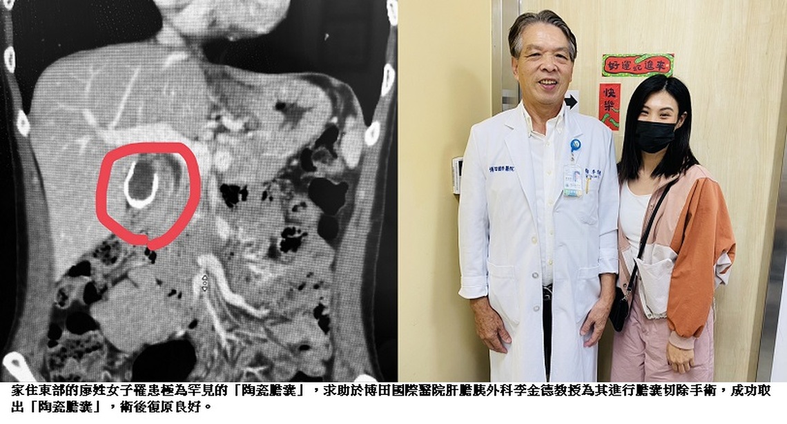 膽囊鈣化成石 罕見陶瓷膽囊現身!