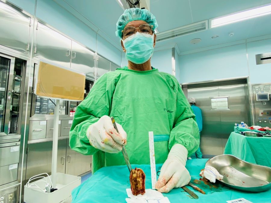 ▲博田國際醫院肝膽胰外科李金德教授以單孔腹腔鏡膽囊切除手術,搭配「靛氰綠(ICG)螢光膽道偵測定位」,精準且安全地切除鈣化膽囊。