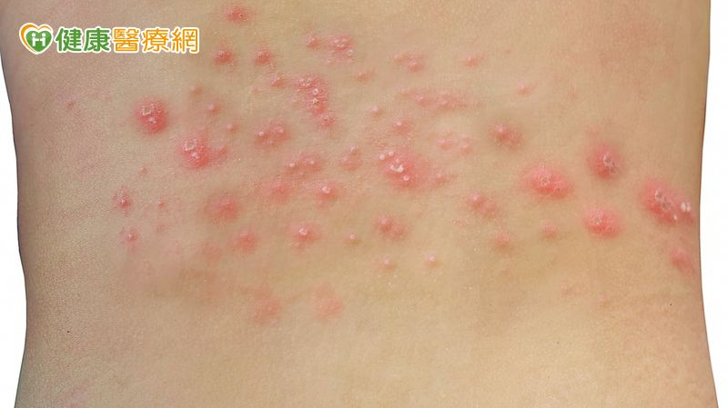 得過帶狀疱疹也可能再復發　醫籲：疫苗接種是防治關鍵