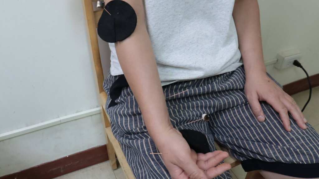 ▲腕隧道症候群,針灸有成效。(彰化醫院提供)