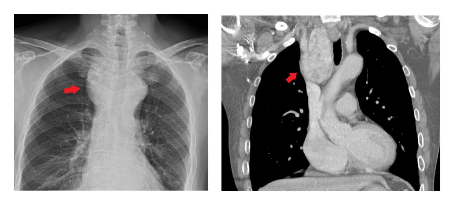 胸部X光及電腦斷層照 0