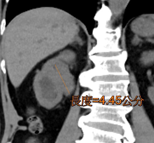 七旬老翁紅尿數月「不痛不理」 頭暈就醫才知罹癌