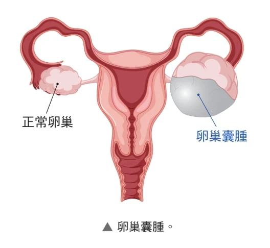  常見的良性囊腫類型 