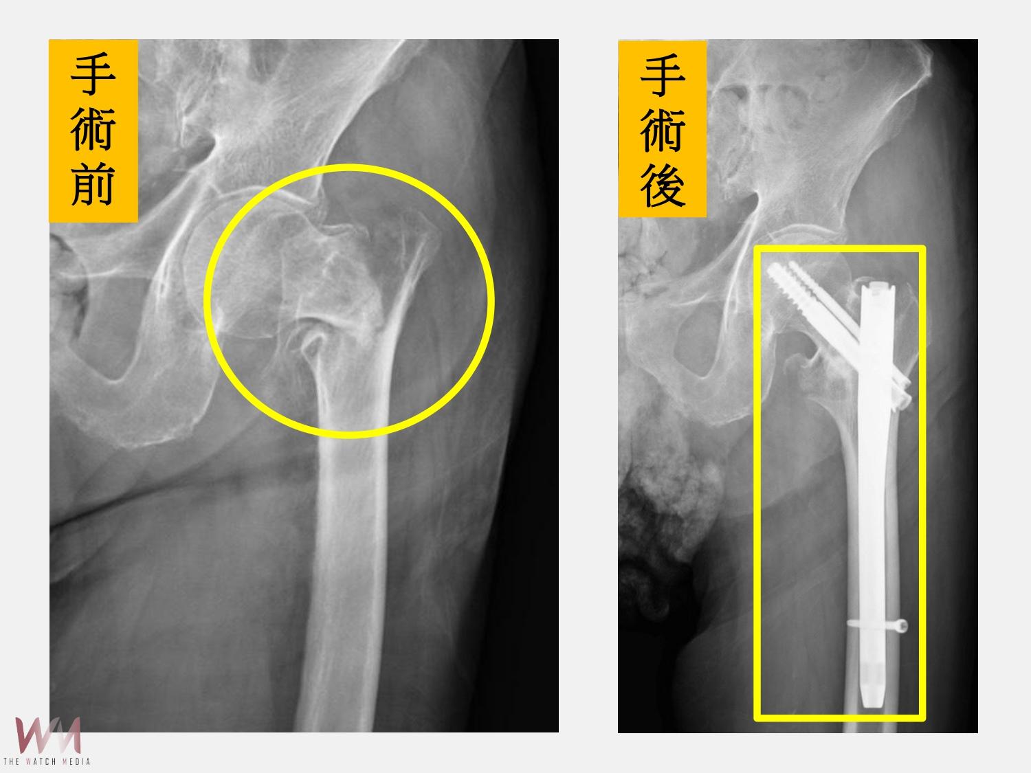 9旬阿祖髖關節骨折 中西醫整合照護 兩週出院享天倫之樂 - https://www.watchmedia01.com