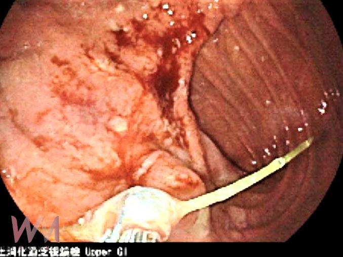 只是腹脹與胃口不佳 竟是魚刺刺入胃壁成膿瘍 - https://www.watchmedia01.com