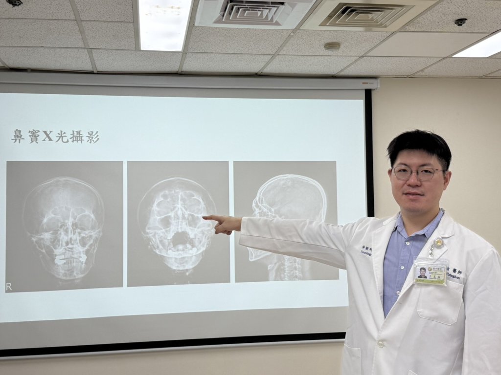 頭痛三個月吃止痛藥沒效-原來是鼻竇炎惹禍