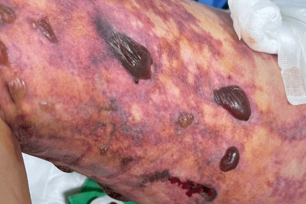 【有影】抽脂變終生洗腎?診所切割責任 陳昭姿籲衛福部整頓亂象 236 照片來源:被害人提供