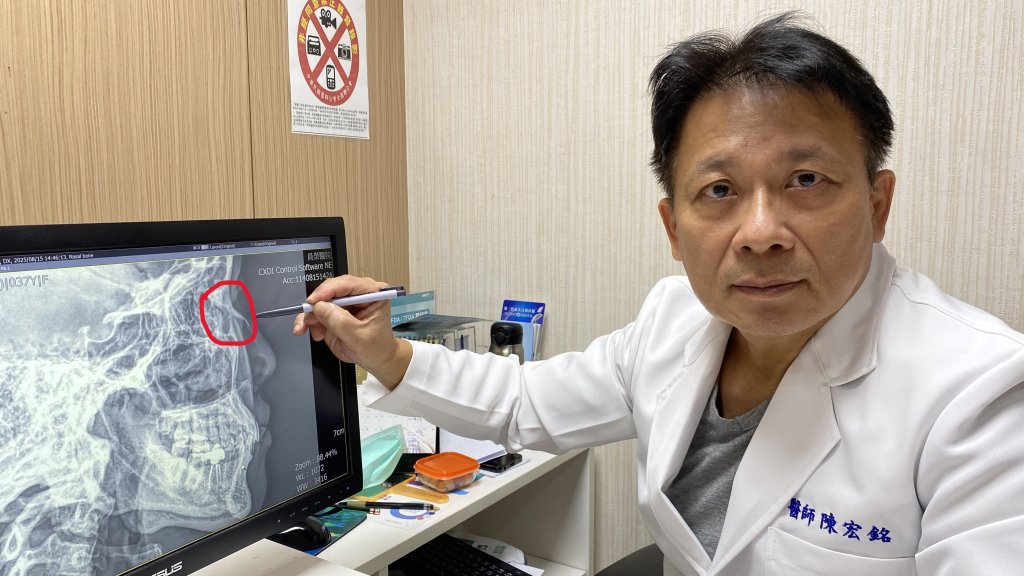 顏面受傷可能傷及骨頭-員榮陳宏銘醫師呼籲患者把握黃金治療期